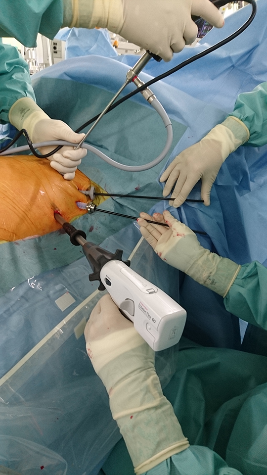 ウルフ―オオツカ低侵襲心房細動手術①