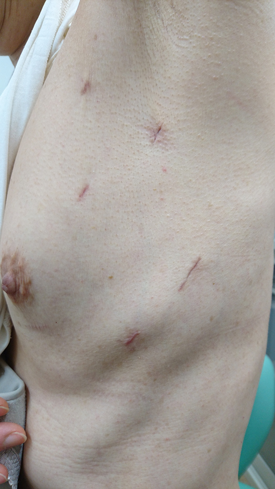 ウルフ―オオツカ低侵襲心房細動手術②