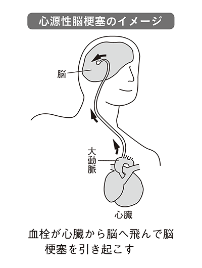 心源性脳梗塞のイメージ