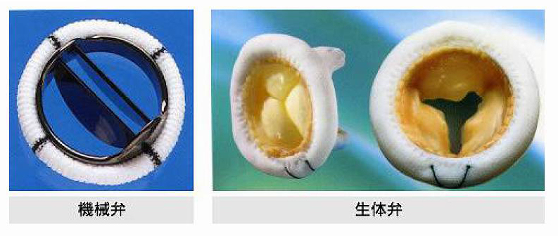 機械弁と生体弁