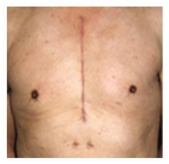 胸骨正中切開の手術跡