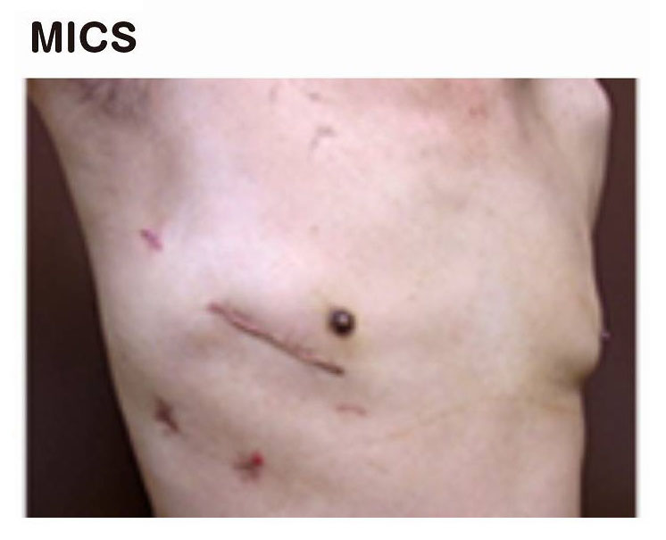 MICS