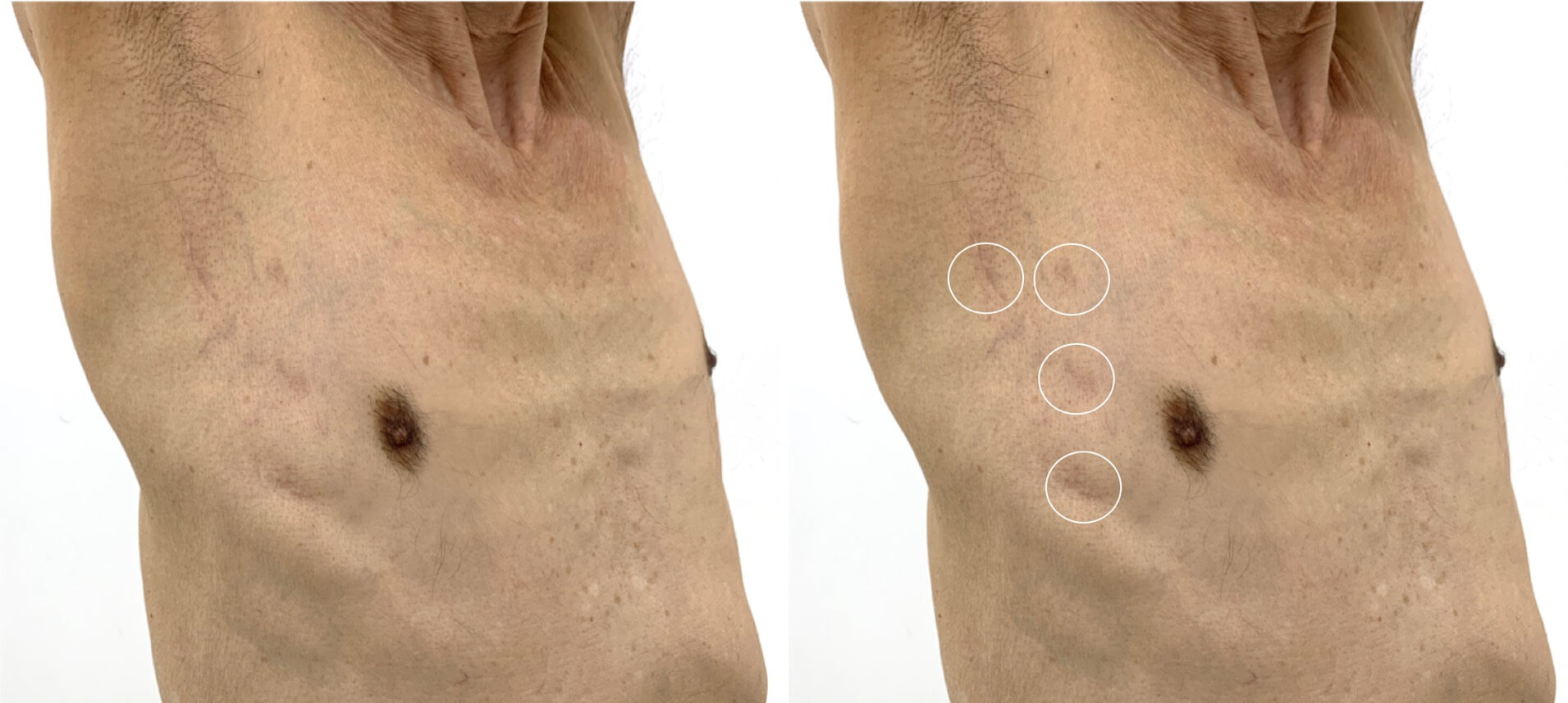 ダビンチ手術の傷跡